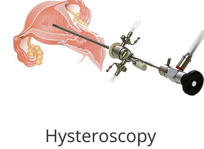hysteroscopya