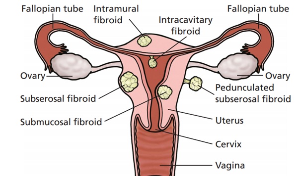 Fibroids Treatment